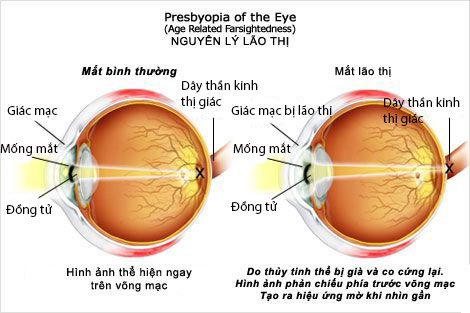 Sự khác nhau giữa mắt lão thị so với mắt bình thường