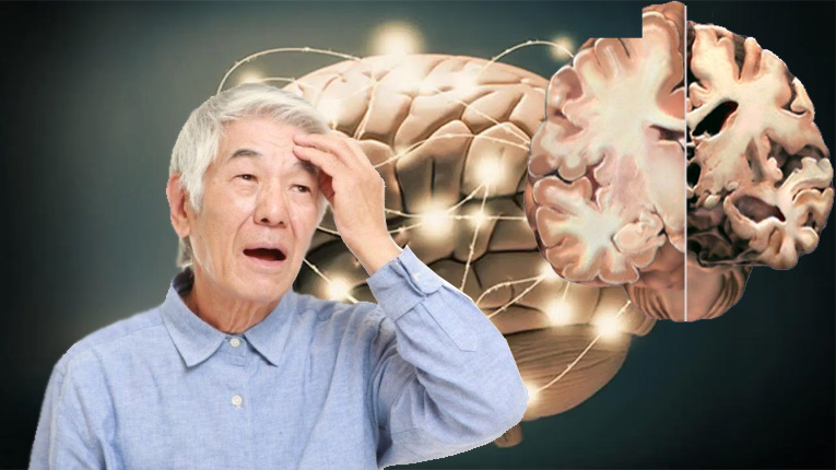 Bệnh Alzheimer thường hay xuất hiện ở tuổi già