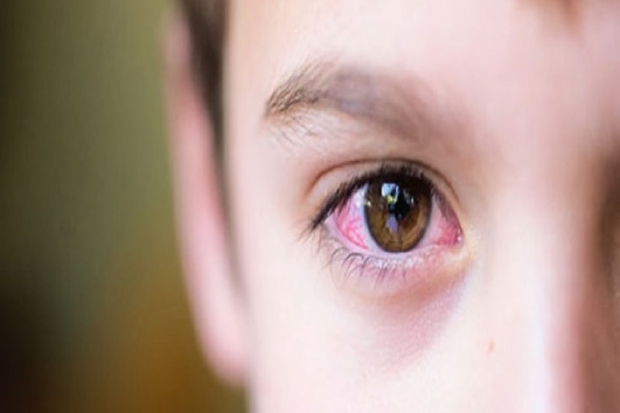 Cường giáp gây ra nhiều biến chứng về mắt