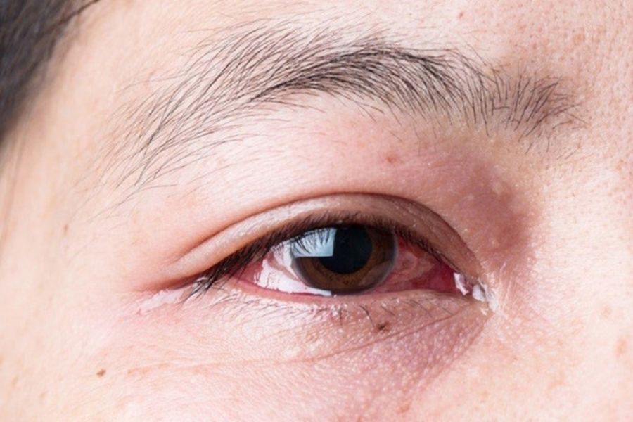 Các dấu hiệu để bạn phát hiện ra mình có đang bị đau mắt đỏ hay không