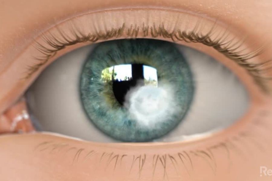 Vùng viêm loét giác mạc mà bệnh đau mắt đỏ để lại sau khi chữa trị