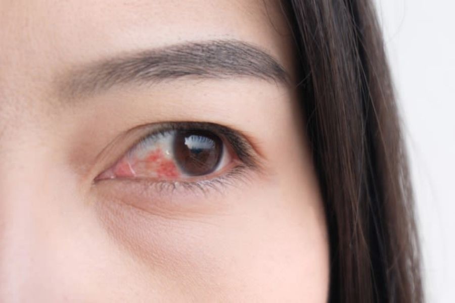Vi khuẩn xâm nhập vào mắt chúng ta gây ra bệnh đau mắt đỏ