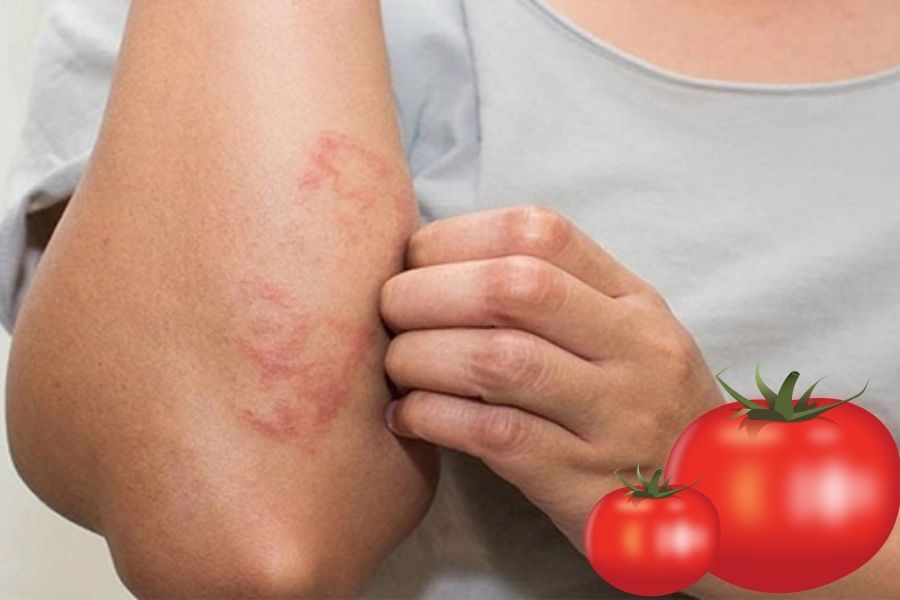 Cà chua có thể gây ra dị ứng, phát ban, mẩn đỏ.