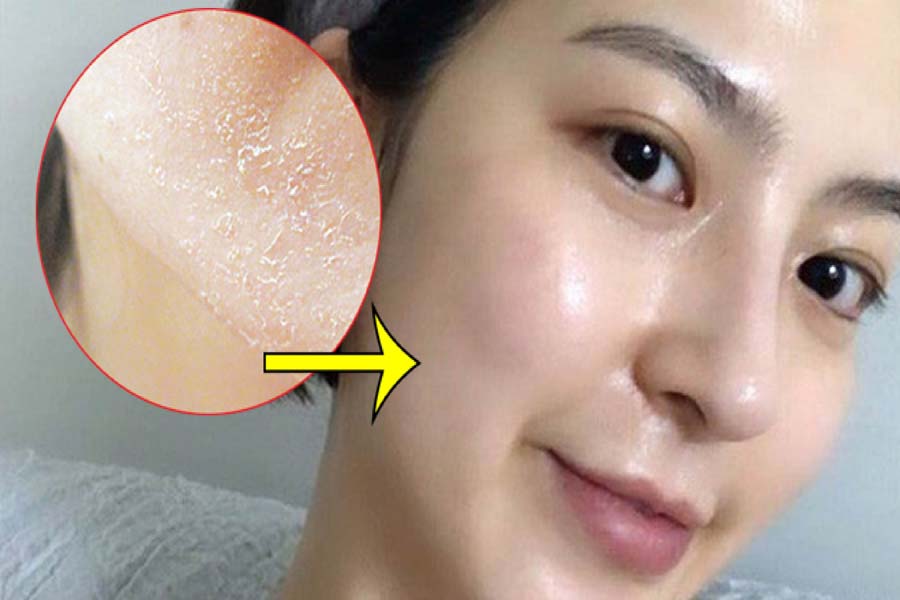 Kem dưỡng ẩm không phải là tác nhân gây nhờn da, không sử dụng kem dưỡng ẩm sẽ khiến da khô.
