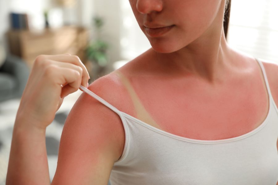 Làn da dễ bị kích ứng với tia UV.