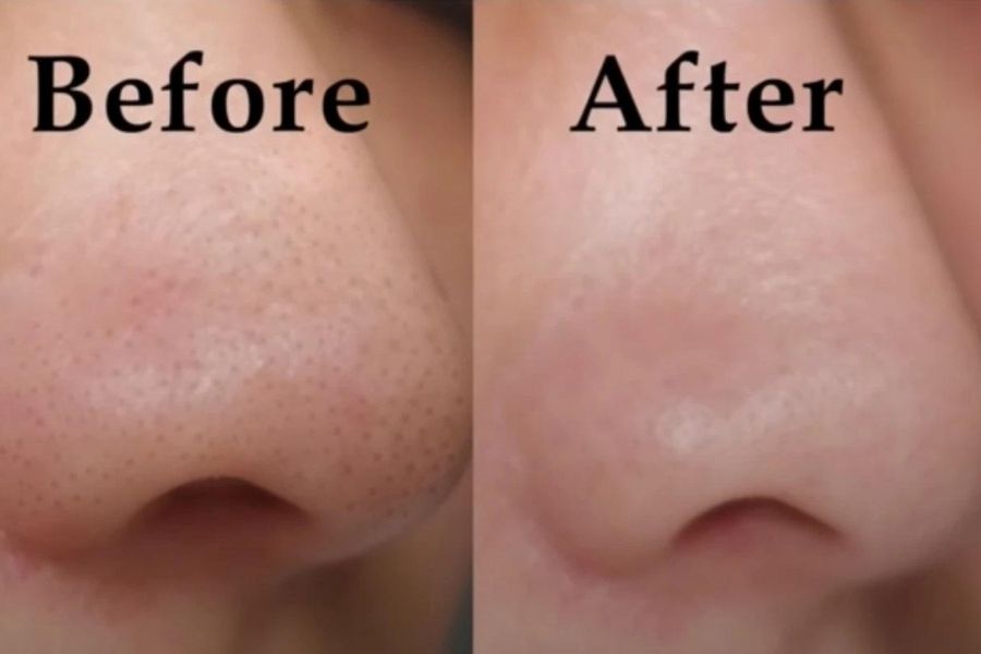 Hình ảnh trước và sau khi trị mụn đầu đen cho mũi.