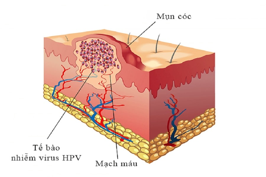 Nguyên nhân dẫn đến mụn cóc là do tế bào bị nhiễm Virus HPV.