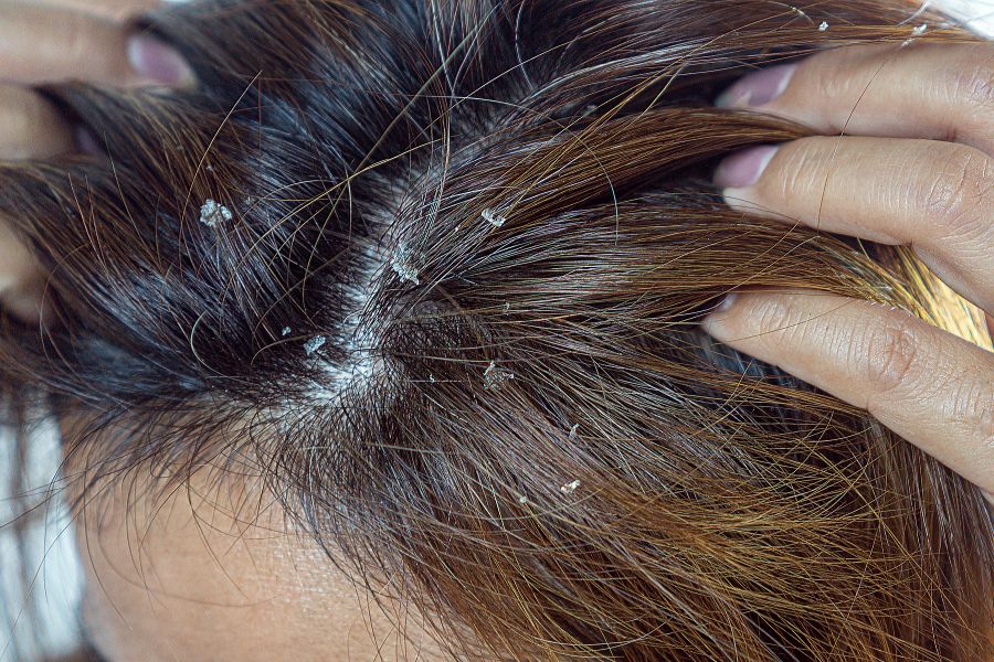 Da đầu bị khô, bong tróc thành mảng không nên tẩy da chết cho da đầu.