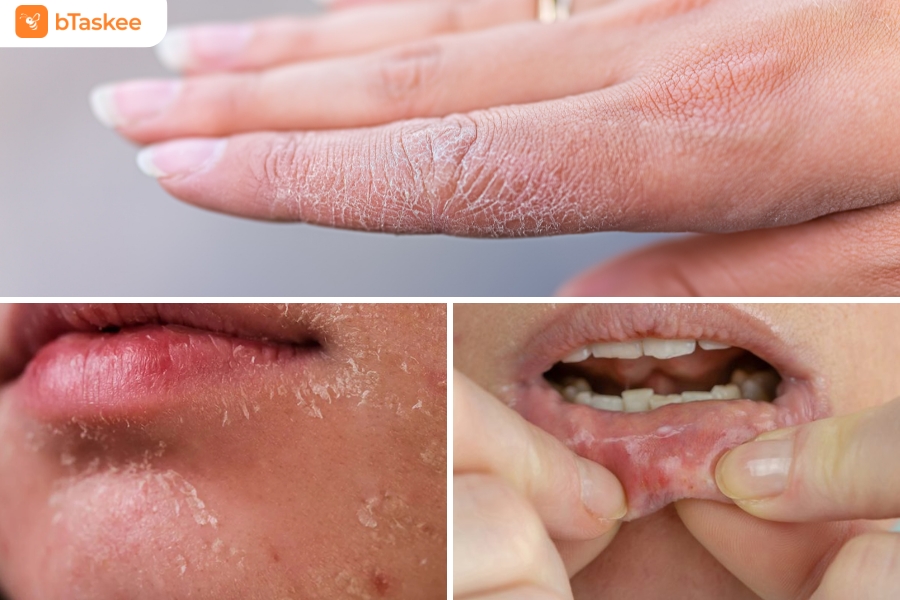 Da khô, nứt nẻ, niêm mạc khô.