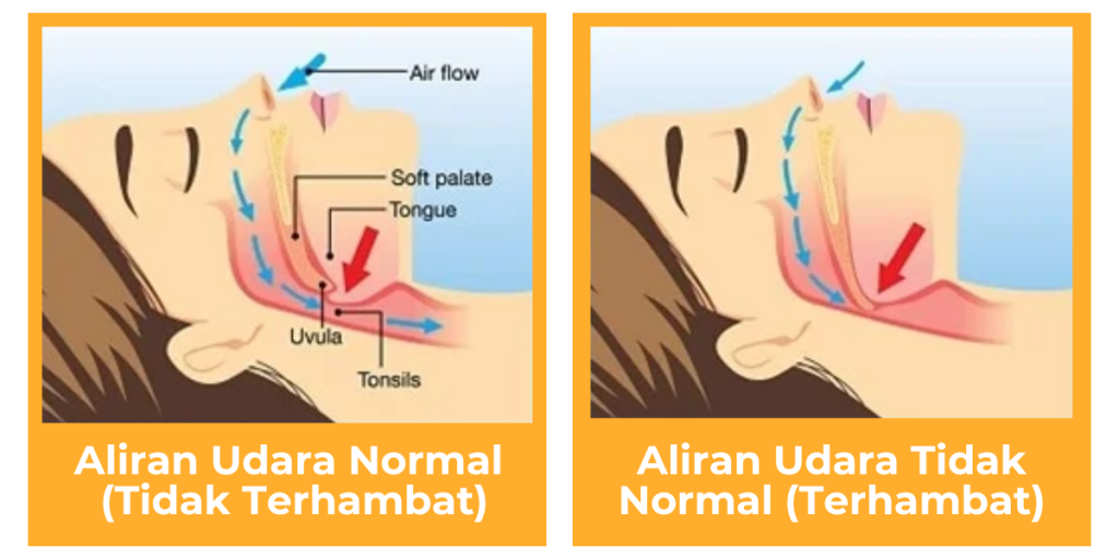 Ngorok terjadi karena adanya getaran jaringan lunak di tenggorokan akibat sumbatan sebagian saluran napas saat tidur.