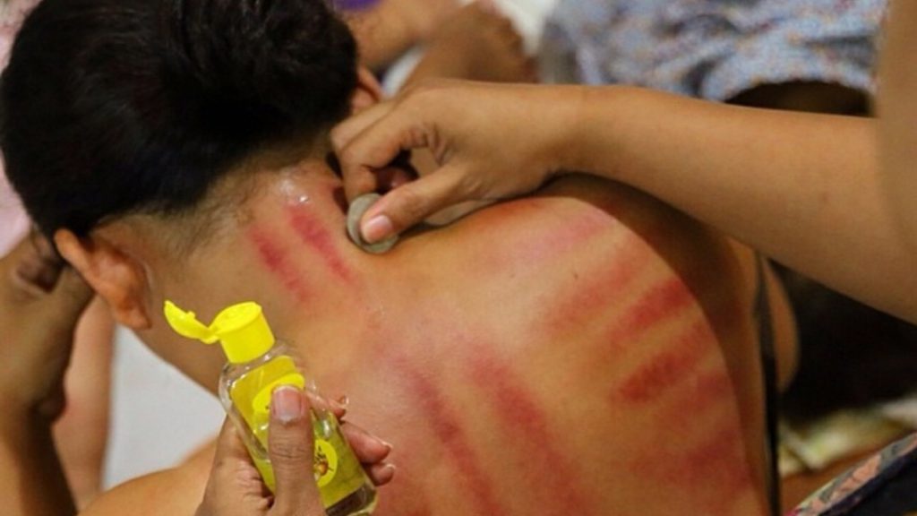 Kerokan / Indonesian coin massage